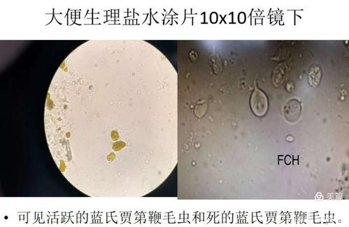 蓝氏贾第鞭毛虫小病例分享
