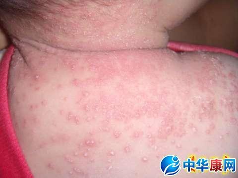 婴儿湿疹症状图片详解