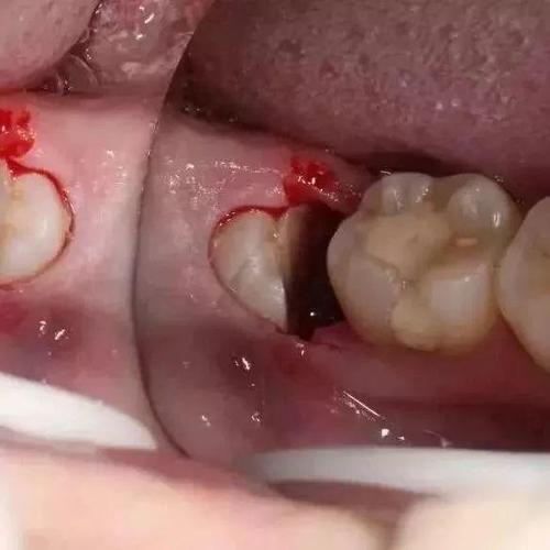 【口腔科普】如何才是"微创拔牙"!