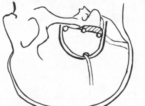 大师手术之kawsse教授颞下经岩骨kawase入路