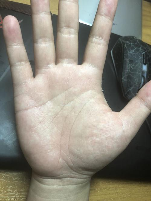 请问这是肝掌么?