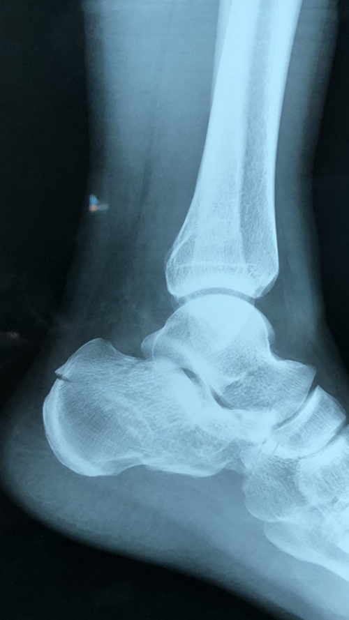 跟骨骨折病例分享