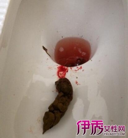 【图】大便带血是什么病症 3种常见疾病要警惕