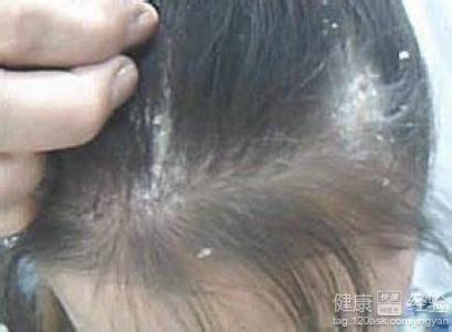 儿童白色头癣怎么治