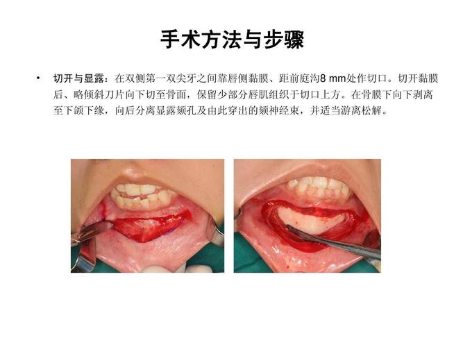 方法与步骤   切开与显露:在双侧第一双尖牙之间靠唇侧黏膜,距前庭沟8
