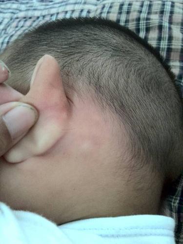 宝宝十个月耳朵后面有个小包