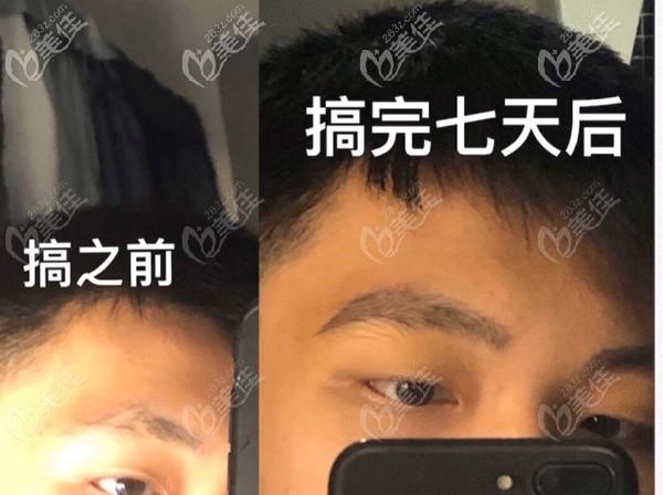 眉毛种植前后对比图