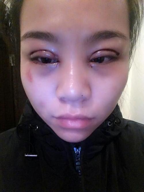 我刚做完双眼皮,眼睛肿得很厉害,还老冒血,到底是怎么回事呀