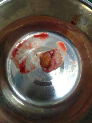 右附件囊性包块:异位妊娠?