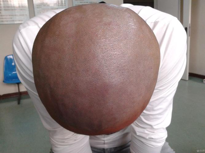 典型病例——头皮脂溢性皮炎