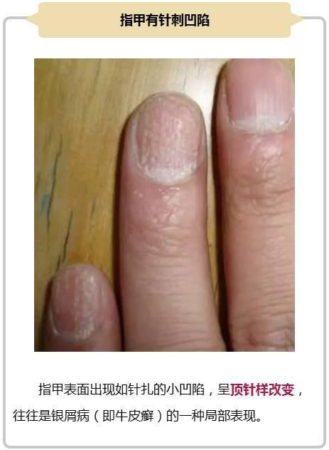 这 8 种指甲问题,一