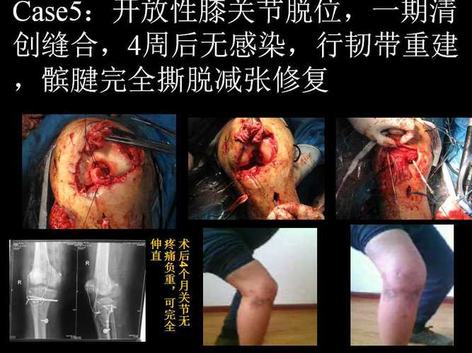 创伤性膝关节脱位的韧带重建治疗策略