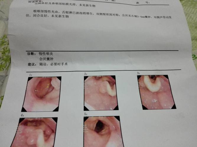 我姨妈检查出来是会厌囊肿,咽口水都痛,医生建议先药物治疗,不行再