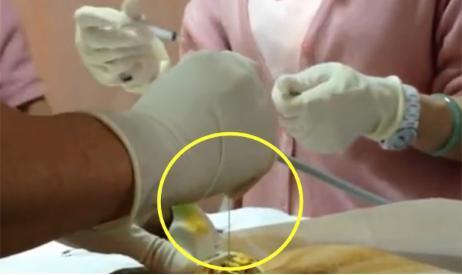 羊水穿刺啥感觉?痛吗?组图还原全程,能坚持到最后的都