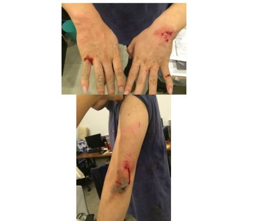 对王正然先生进行拳打脚踢,导致其头部,手臂,后背等多处受伤流血