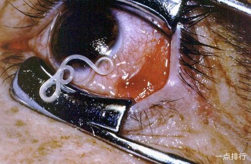 全球十大最恐怖的寄生虫 胆小勿入真的很渗人