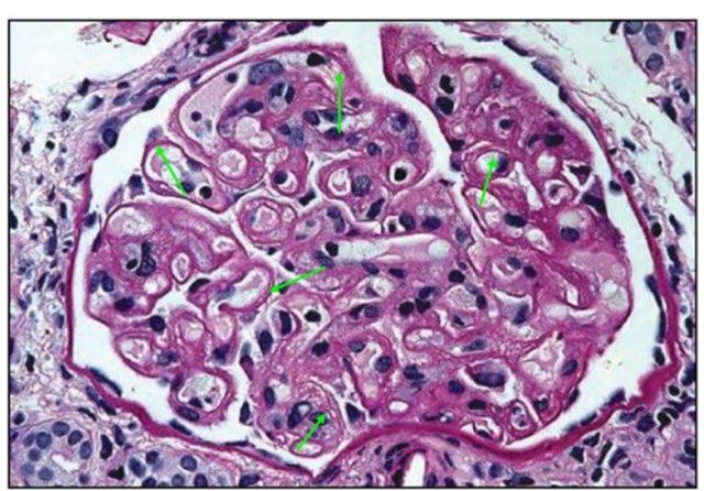 肾内病理图解:血栓性微血管病