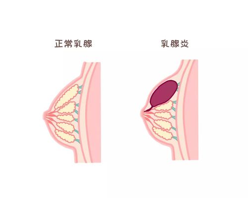 为什么母乳妈妈总是得乳腺炎