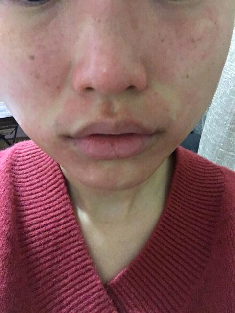 用了自然之名洋甘菊面膜严重过敏