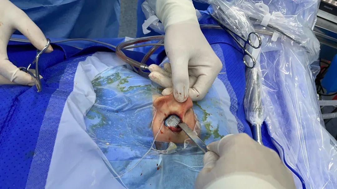 特许人工耳蜗引入公立医院 首例海南籍双侧极重度耳聋