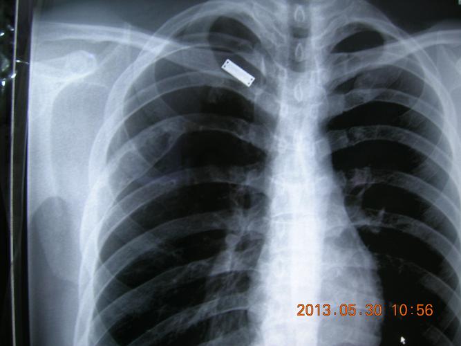 肿瘤看看片子肋骨病变待查