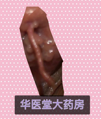 假性湿疣与尖锐湿疣辨别图(密集恐惧勿点)