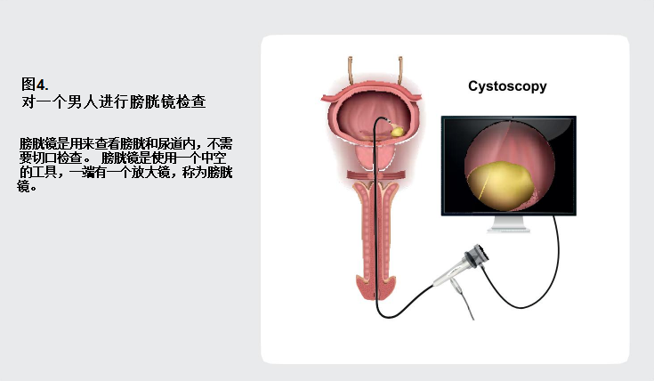 谈癌色变之——被膀胱癌缠上了该怎么办?