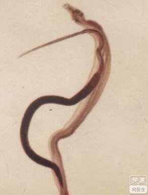 血吸虫病的症状图片是怎么样的