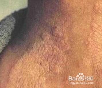 2 若是脖子痒得厉害,反复抓痒,会导致皮肤增厚,粗糙,这考虑神经性皮炎