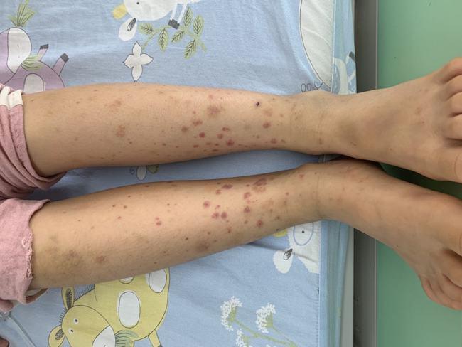 得了这个病一定不能剧烈运动|过敏性紫癜|皮疹