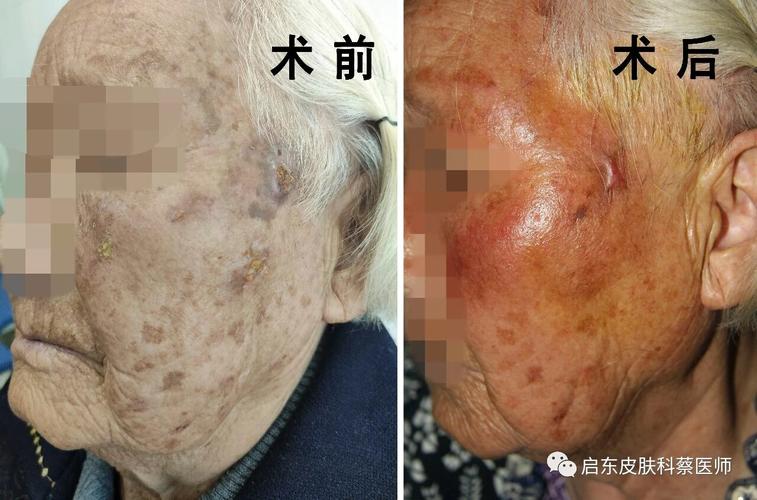 90岁的患者面部scc合并日光性角化一例