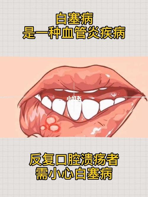 反复口腔溃疡可能是白塞病_口腔溃疡_白塞病_医疗健康