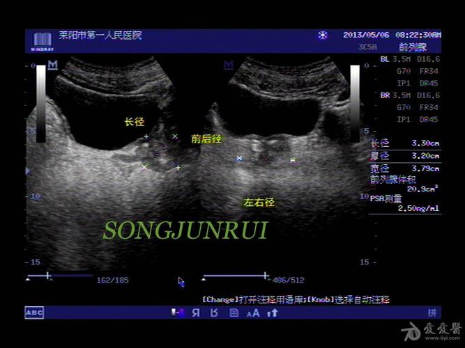 超声入门贴70-----前列腺测量方法