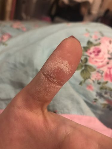 双氧水擦了擦手指变成这个样子 求解?严不严重啊有没有事?