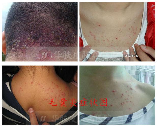 毛囊炎症状