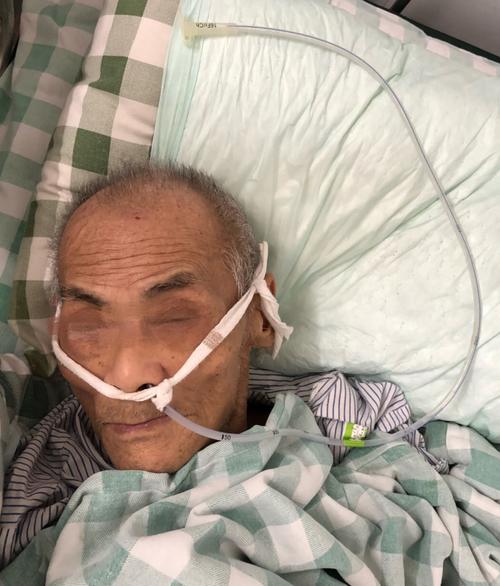 告别鼻饲管,拒绝胃造瘘,使用ioe