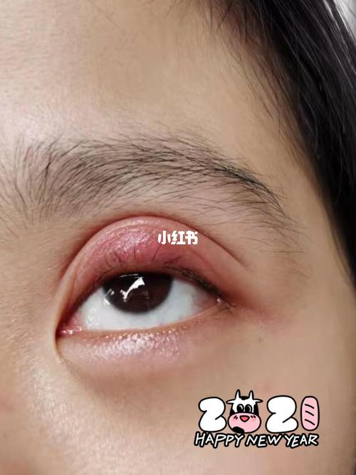 麦粒肿_双眼皮_医疗健康_医疗健康其他