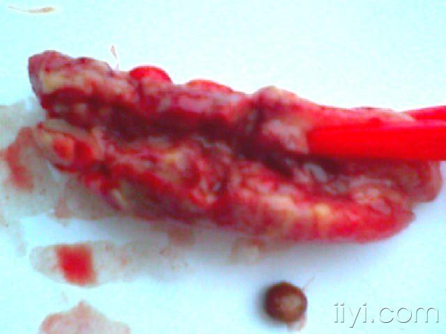 分享经典病例化脓性阑尾炎穿孔伴腔内粪石超声图片及术后标本比对