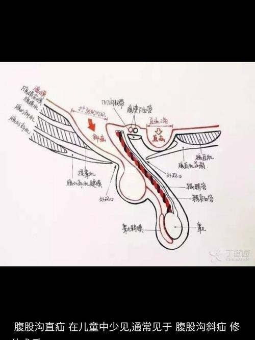 腹股沟斜疝和直疝_医疗健康_医疗健康其他