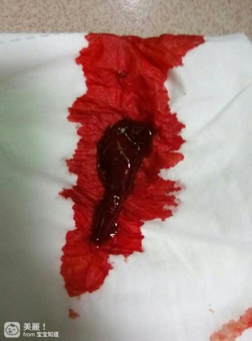 然后就流血不止,赶快去了医院照b超,b超照完医生告诉我,胎儿已经掉了.
