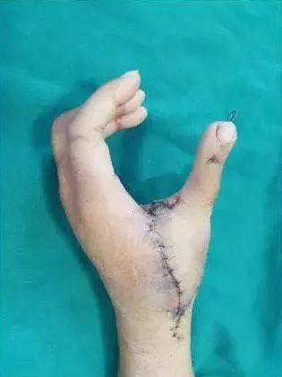 浙江| 一女子的大脚趾"变身"大拇指!这是无奈之举!