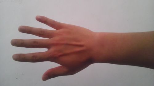 打羽毛球右手手腕及手背疼,可能是腱鞘炎,请专家帮忙诊断下.