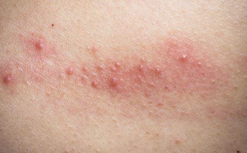 如何摆脱接触性皮炎困扰
