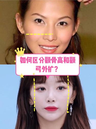 颧骨高和颧弓外扩有何区别?