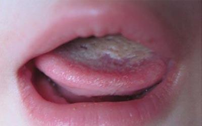 宝宝的舌头厚白可能是因为消化不良引起的