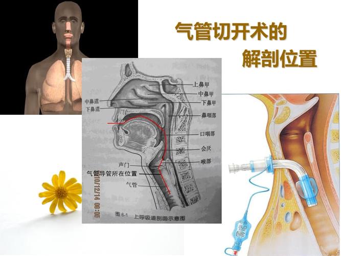气管切开病人的伤口护理.ppt