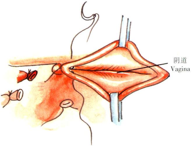 筋膜外扩大全子宫切除术