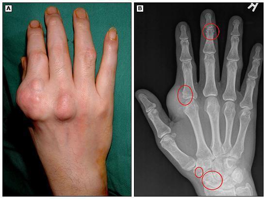 囊肿肿物肿瘤?别傻傻分不