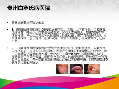 贵州白塞氏病医院.ppt