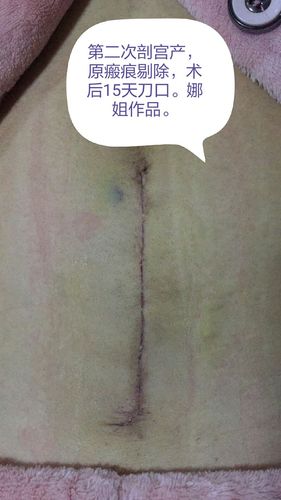 剖宫产及侧切刀口如何预防瘢痕?